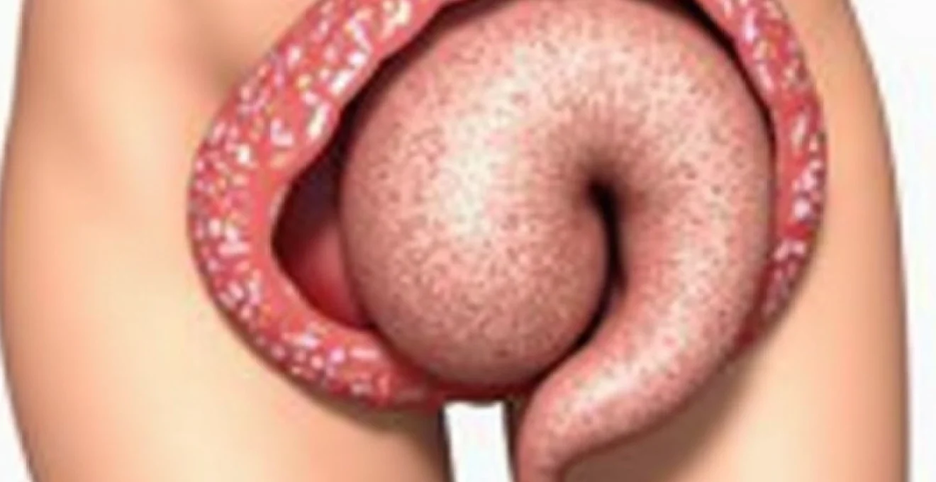 a-painless-bump-near-the-anus-common-causes